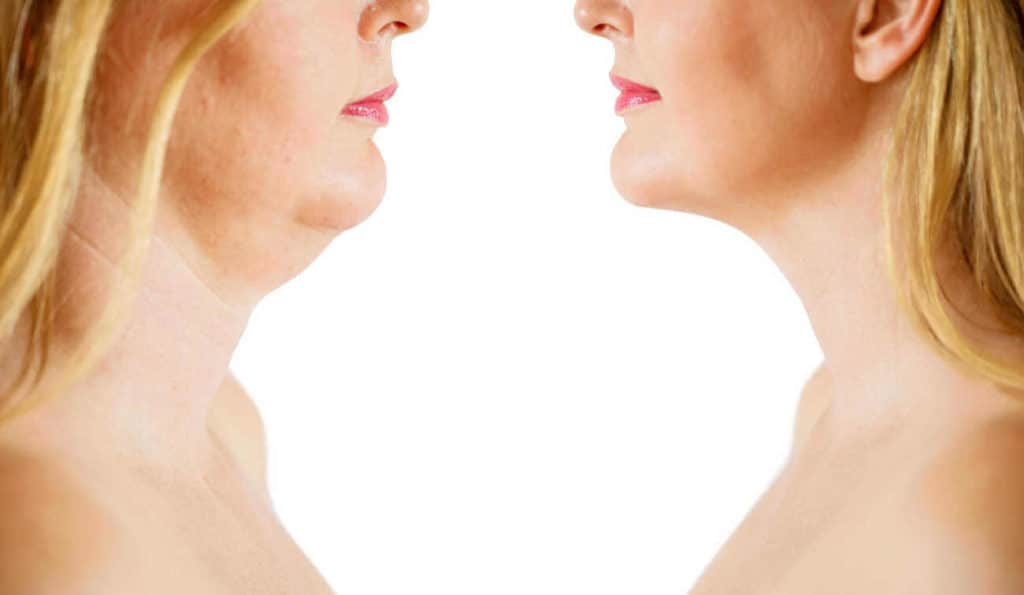 Double Chin treatment Knightsbridge before and after results