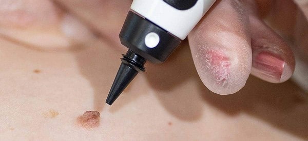 After Skin Tag Removal Knightsbridge