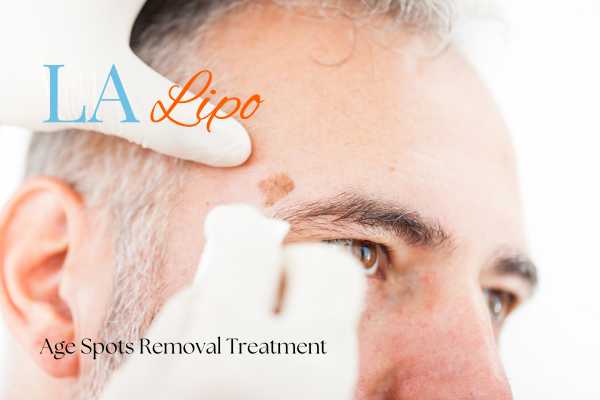 What Are the Most Effective Treatments for Age Spots Knightsbridge?