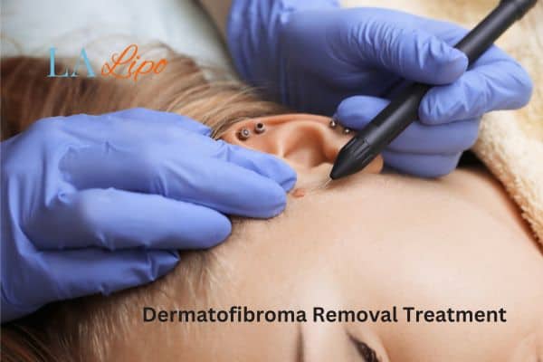 Dermatofibroma Removal Treatment Knightsbridge
