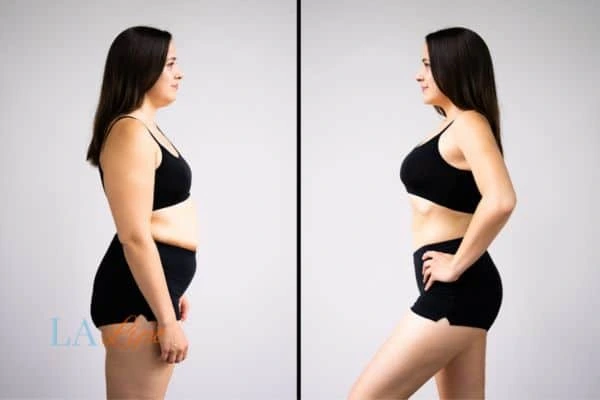 image of woman before and after results of LA-EMS Body Sculpting Knightsbridge to help treat Diastasis recti