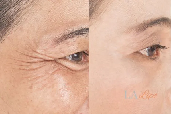 Before and after results of woman - HI-fu wrinkles reduction treatment Knightsbridge