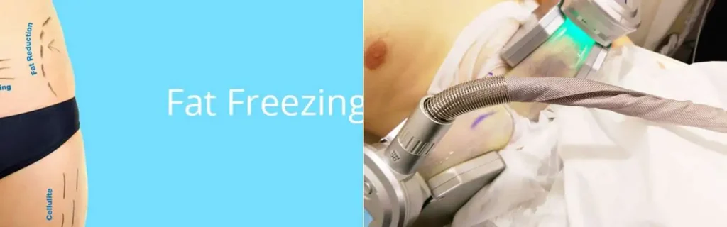 Fat freezing Knightsbridge on multiple areas of the body