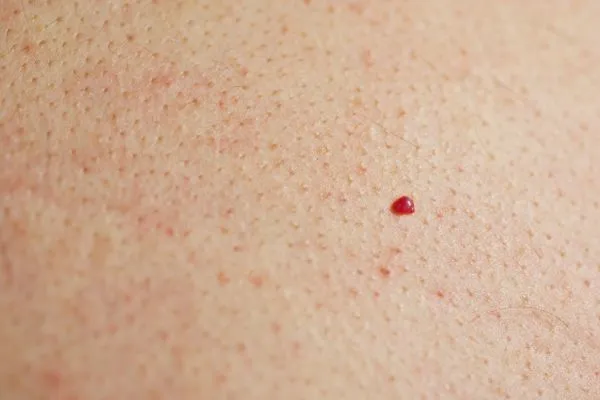 close up of a cherry angioma Knightsbridge