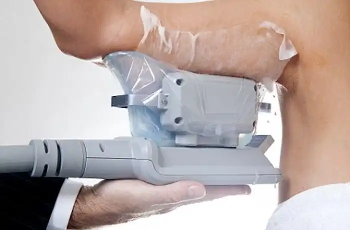 Picture of fat freezing Knightsbridge on the upper arms.
