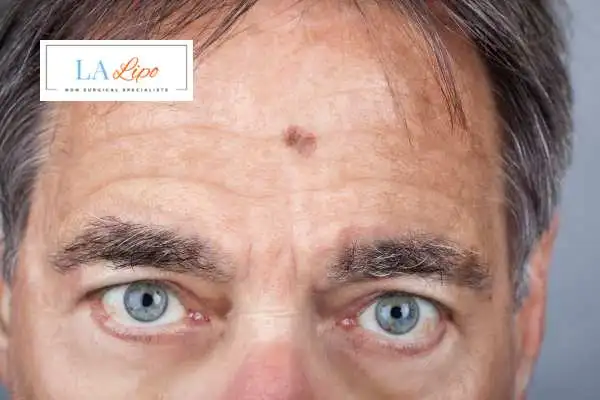 Solar Lentigo Removal Knightsbridge image of man with mark on his forehead