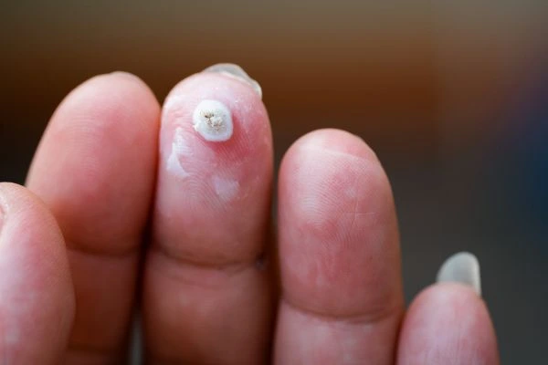 wart on person finger - cryotherapy to treat from LA LIPO Knightsbridge