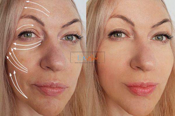 Morpheus 8 results Knightsbridge face lift.