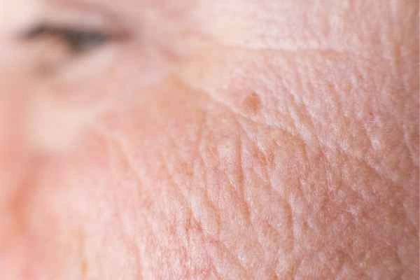close up picture of a woman's face showing an age spot Knightsbridge