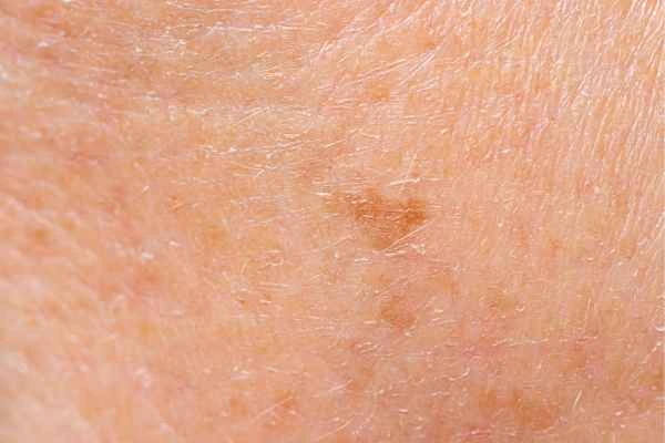 close up picture of age spots Knightsbridge