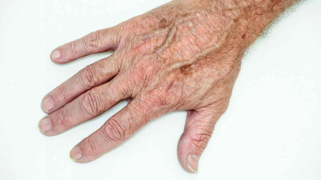 Male hand showing age spot Knightsbridge