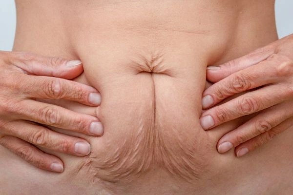 Should I Combine Diastasis Recti Treatment with Body Contouring for Better Results Knightsbridge?