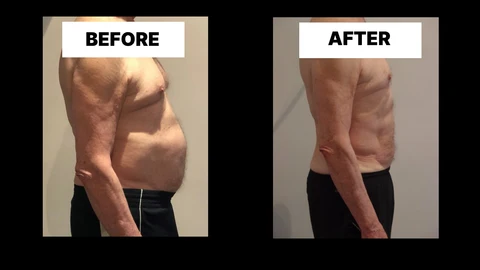 What Symptoms Can Diastasis Recti Cause in Men? Weak Core, Back Pain and Poor Posture Knightsbridge